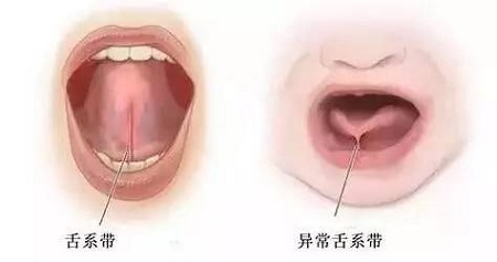 舌系帶過(guò)長(zhǎng)影響孩子發(fā)音,嚴(yán)重不會(huì)說(shuō)話